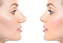 Ready to Transform Your Appearance With a Nose Surgery in Dubai?